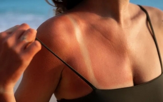 Verano y sol: guía esencial para cuidar tu piel del daño solar