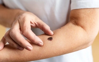 “En promedio, por día se atienden entre dos y tres personas con cáncer de piel”