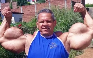 Muere el “Popeye brasileño”, famoso por inyectarse aceite en los brazos