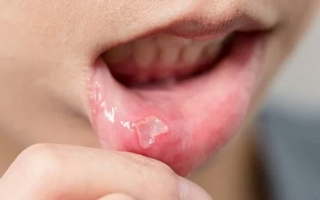 Los casos de sífilis se disparan un 26% en Argentina por una vía de contagio poco conocida