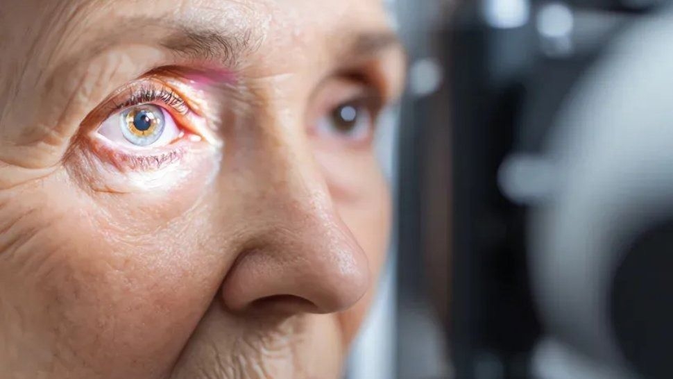 Glaucoma: aconsejan hacerse estudios ya que detectarlo a tiempo evita la ceguera