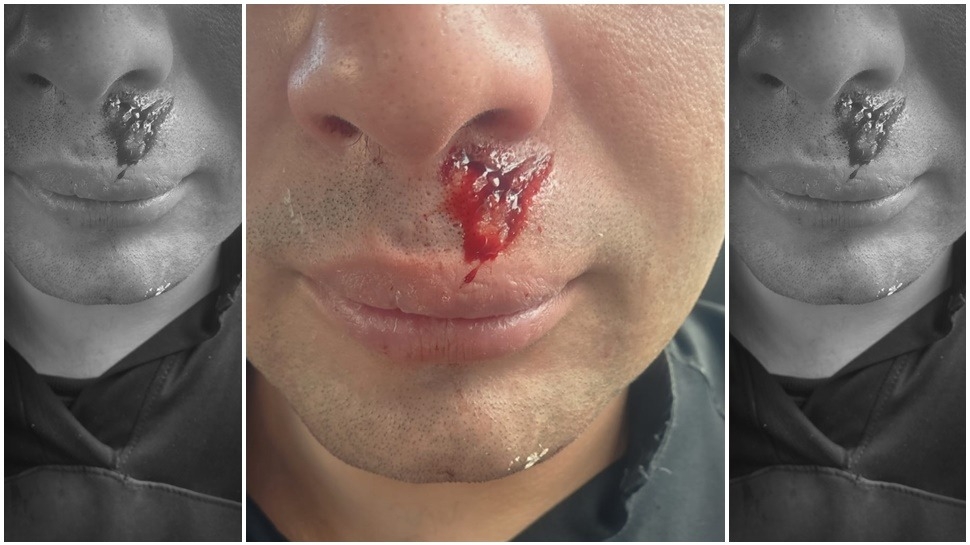 Atacaron a piedrazos a un policía y terminó con una profunda herida en el rostro