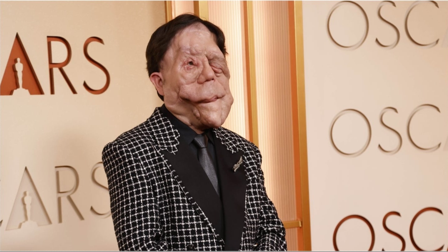 Adam Pearson: el actor con neurofibromatosis que brilló en los Oscar