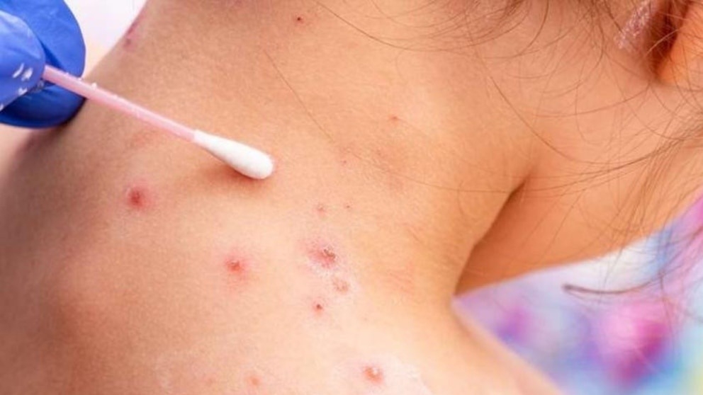 Detectaron en Argentina el primer caso de la variante más potente de la Viruela del Mono