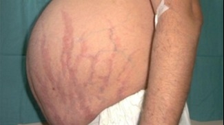 Pocos sanjuaninos detectan que tienen síndrome de Cushing: qué es y cómo se trata