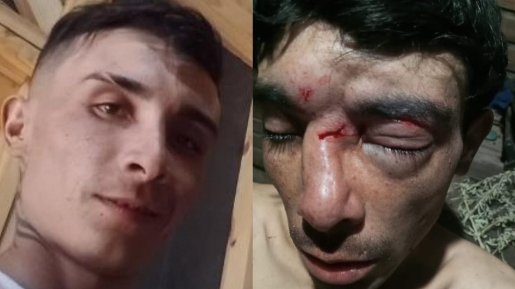 Un joven necesita $6 millones para operarse tras ser desfigurado por ladrones