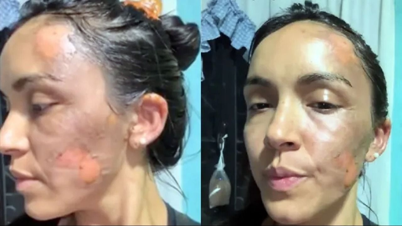 Una mujer quemó a otra con agua hirviendo en un ataque de celos