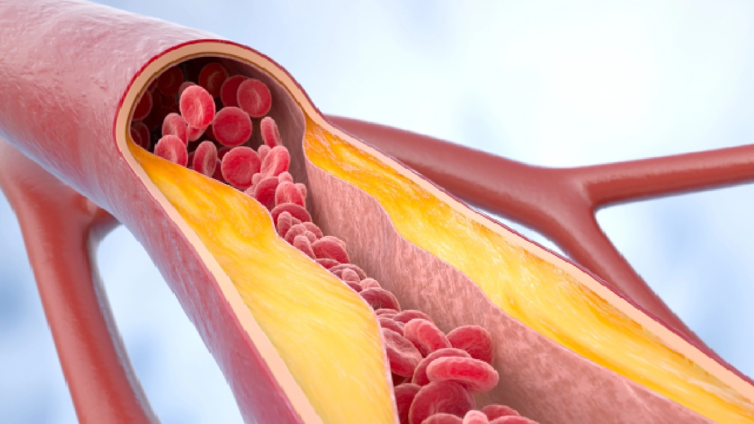 Científicos hallaron tratamiento para el colesterol de origen genético