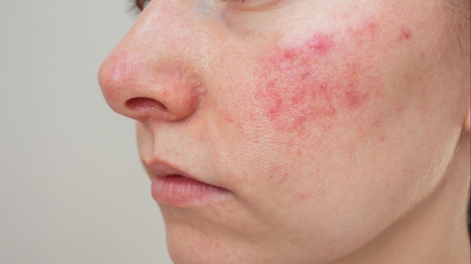 Cómo el estilo de vida ayuda a combatir los brotes cutáneos