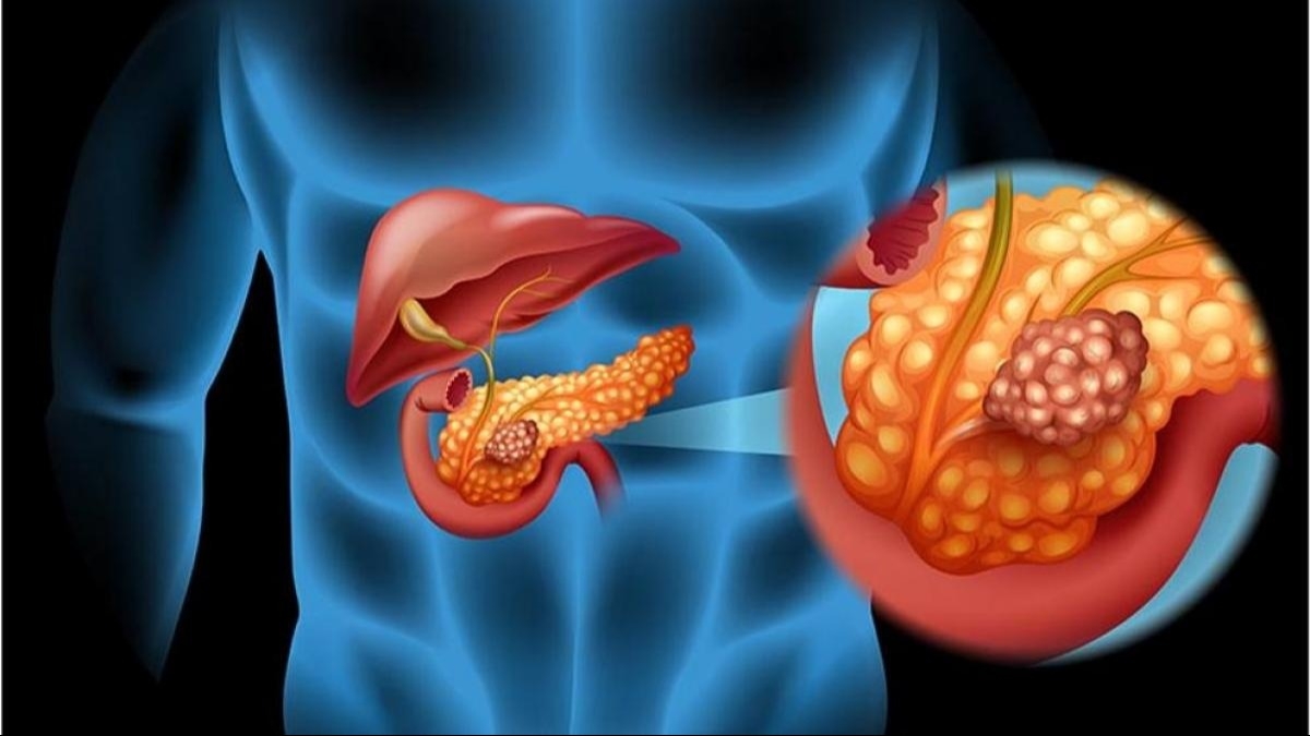 El uso de la IA que puede salvar vidas detectando cáncer de páncreas