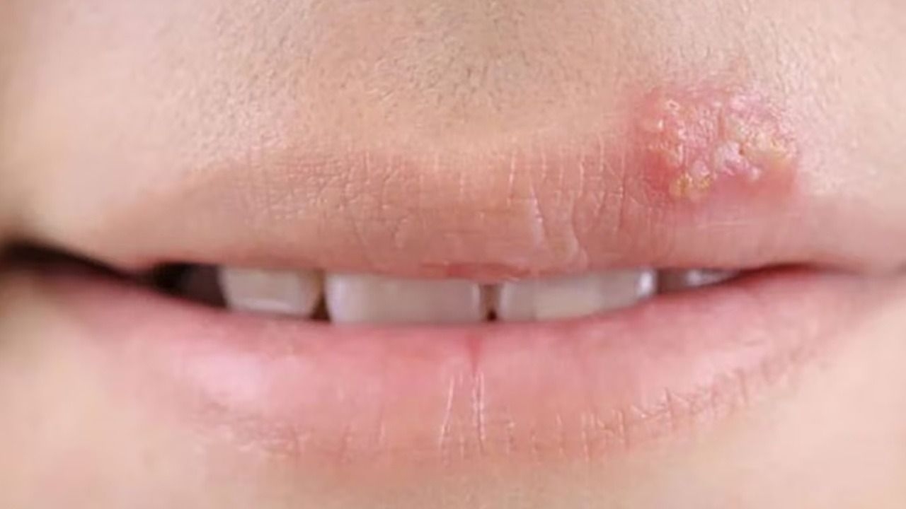 Herpes: qué lo reactiva y por qué hay que prestar especial atención cuando afecta los ojos