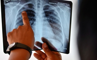 Alerta por tuberculosis: 1.225 casos más que el promedio