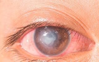 Despertar con visión borrosa: causas comunes y cuándo consultar al médico