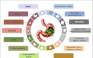Cáncer gástrico: síntomas y dieta recomendada