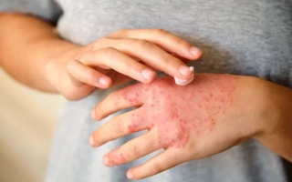 Día Mundial de la Dermatitis Atópica: causas y tratamientos