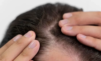Cinco causas de la caída del cabello y cómo evitarla