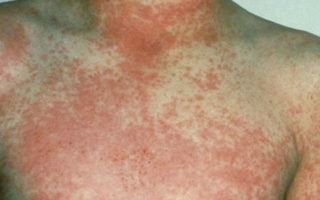 Descartaron el brote de varicela y escarlatina en la escuela iglesiana