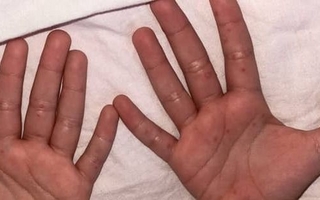Todo lo que debes saber sobre el virus de manos, pies y boca