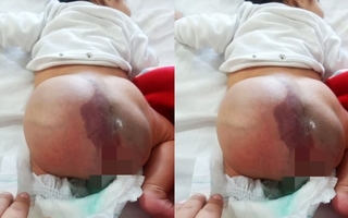 Una mamá pide ayuda para tratar a su bebé que padece una malformación