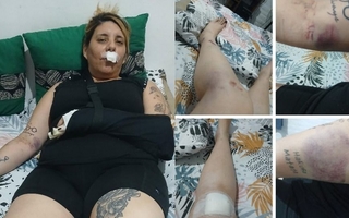 Una sanjuanina pide ayuda tras sufrir un grave accidente de moto