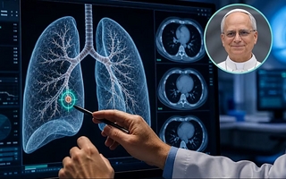 Qué es un nódulo pulmonar y por qué operarán a León XIV
