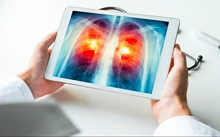 Que es un adenocarcinoma pulmonar que le encontraron al papa León XIV