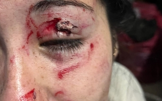 Una madre y su hija desfiguraron a golpes a una mujer