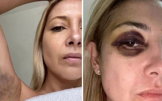 Fabiola Yáñez reveló si fue mentira lo de sus fotos con el ojo morado y moretones