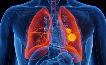 Aumentan casos de cáncer de pulmón y crece la necesidad de tamizaje