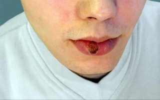 Argentina registra la mayor cifra de casos de sífilis de su historia