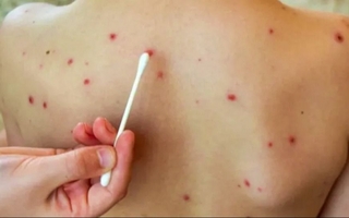 En San Juan, un 15% de niños mayores de 5 años no están vacunados contra el sarampión