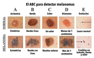 La regla ABCDE para detectar cuándo consultar al dermatólogo por lunares