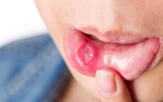 Estos son los factores de riesgo del cáncer bucal