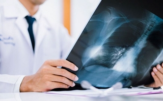 Cáncer de pulmón: “El 80% de las veces que diagnosticamos llegamos tarde”